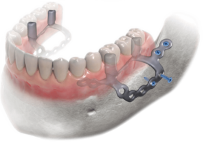 Eaglegrid foto griglia mini mandibolare